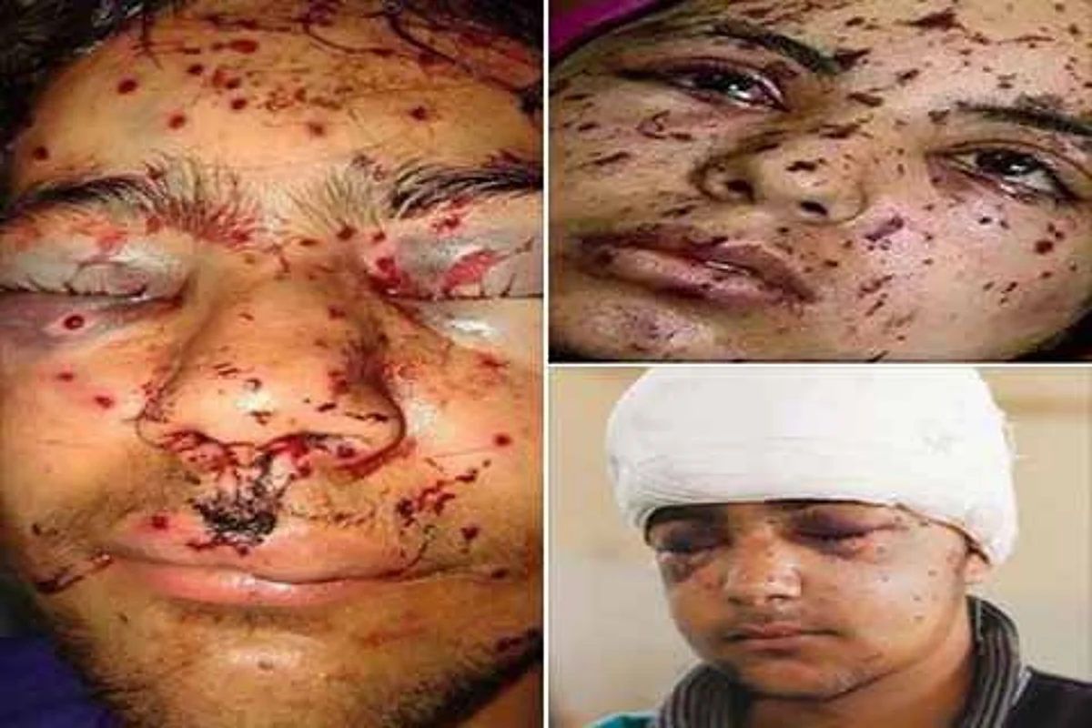 Pellet injury in eye