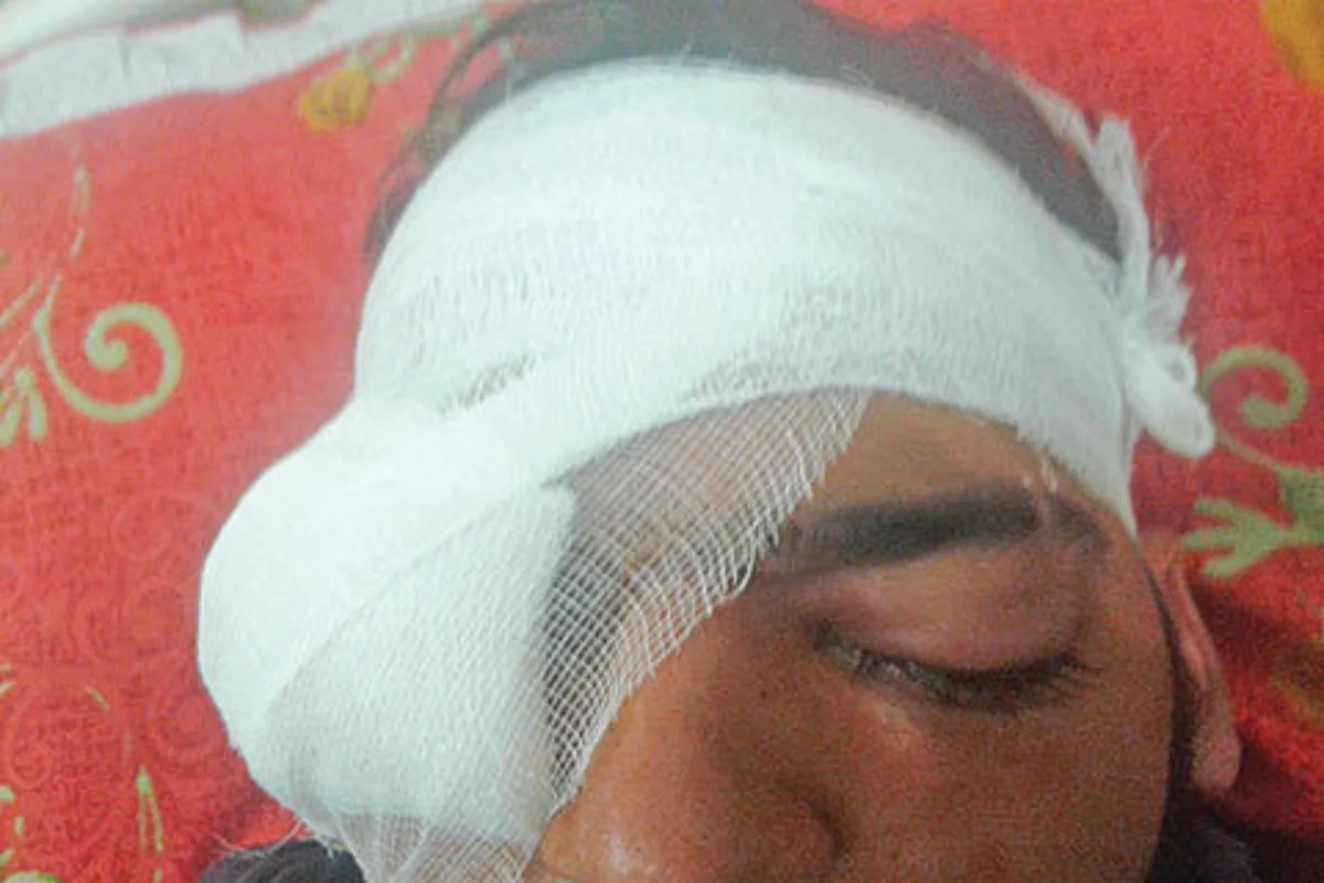 Pellets snatch both eyes of Srinagar youth