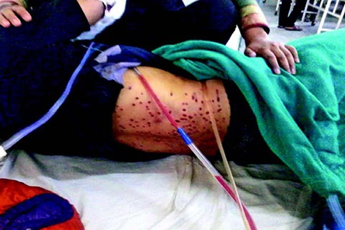 ‘Hit by 300 Pellets, Parimpora youth’s vital organs damaged’