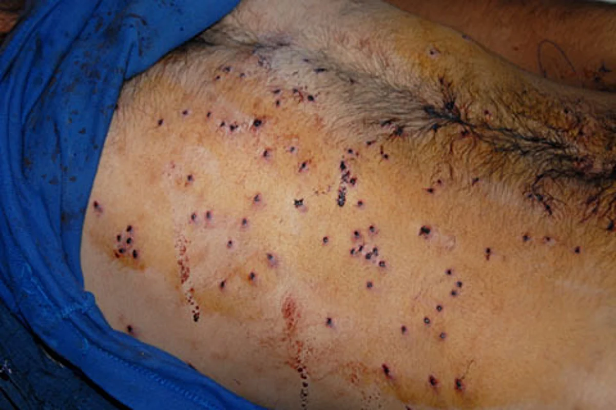 Youth injured in Bandipora clashes
