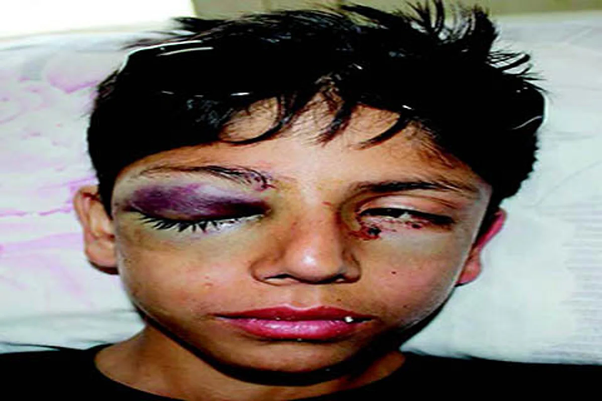 Pellets in eye, 12-yr-old asks: Why did they shoot at me?