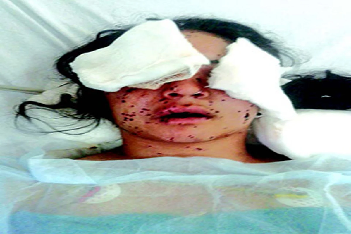33 pellet victims have dead eyes, hundreds others ‘just perception of light’