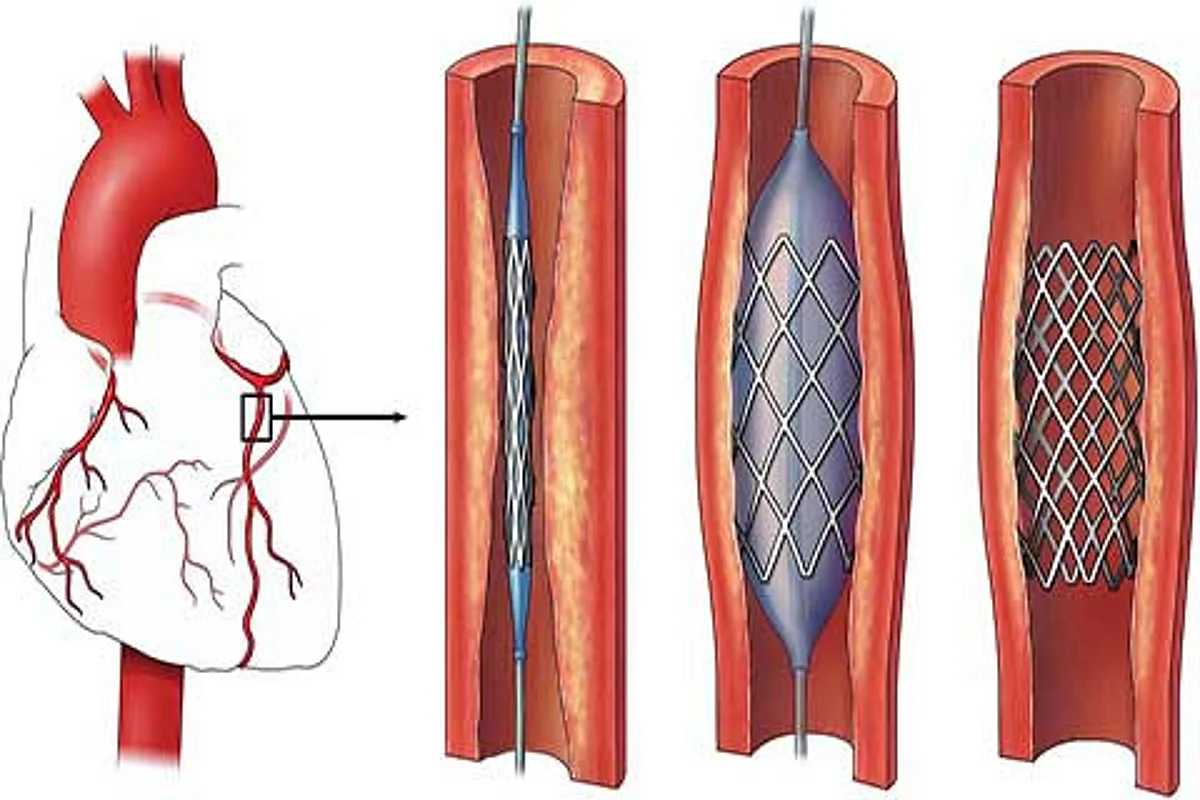 As cardiac stents go cheaper, Kashmir hospitals overcharge: DAK