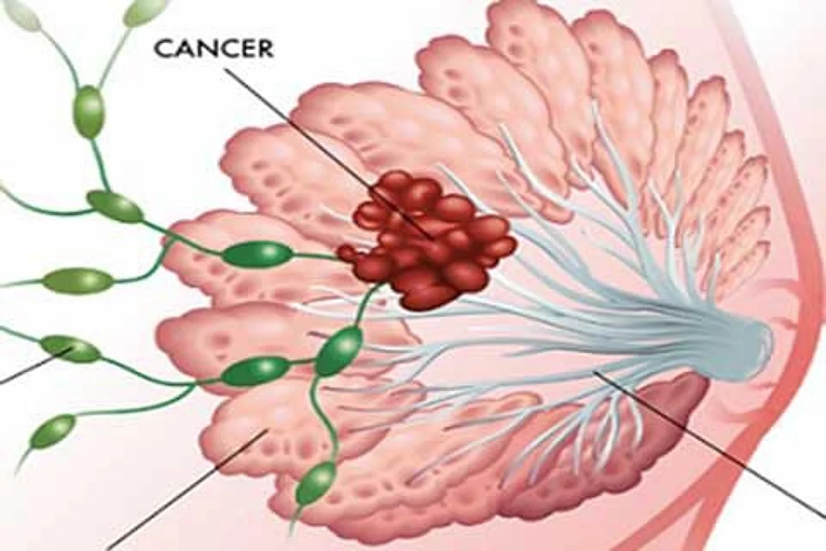 Breast cancer drug linked to brain malfunction