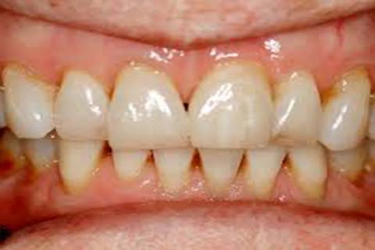 Oral Health Care |Considerations during Ramadhan