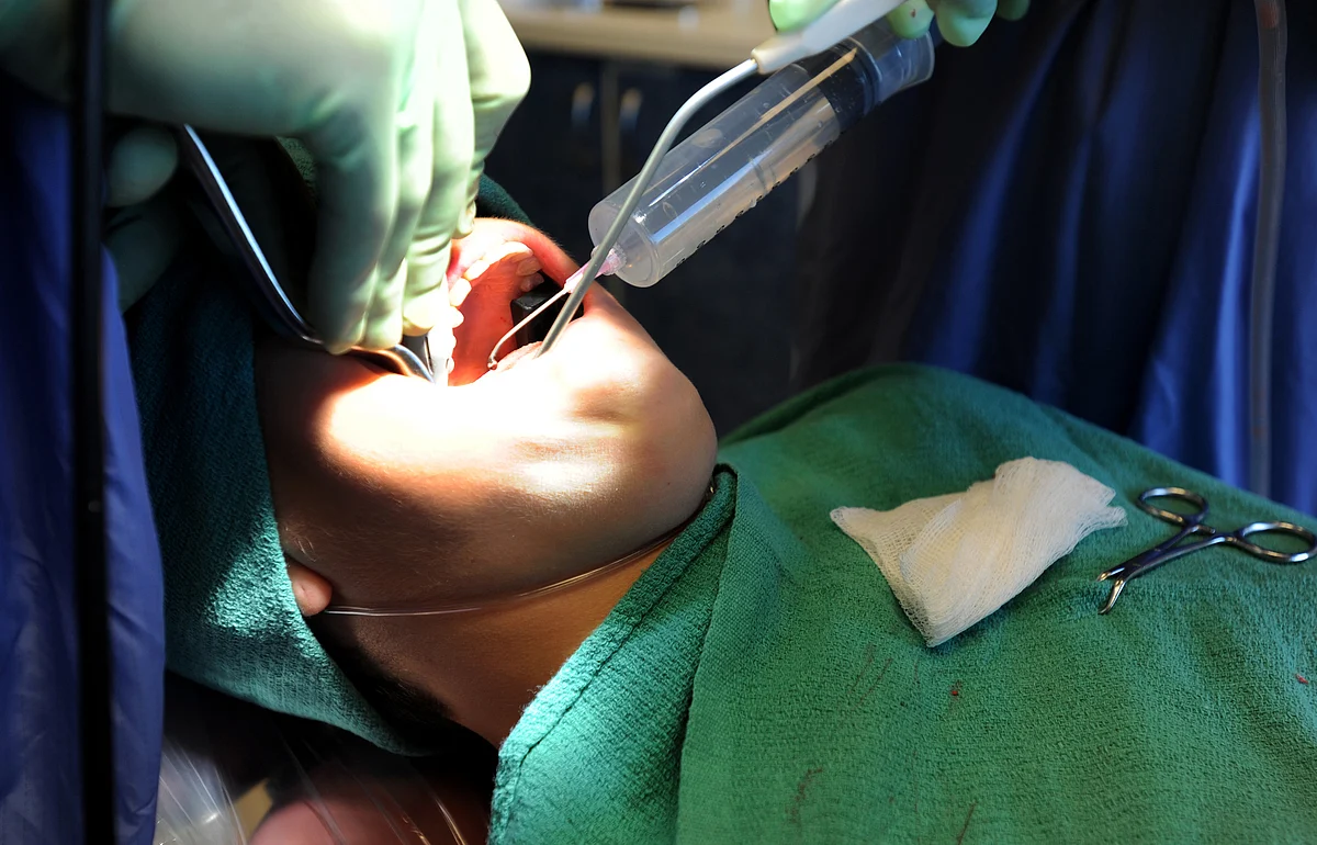 Chennai doctors extract 526 teeth from 7-year-old’s mouth