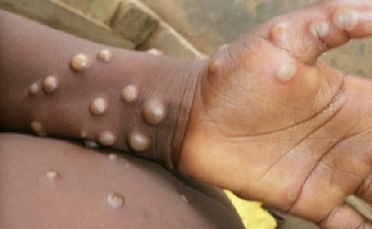 TN to isolate int'l travellers with monkeypox symptoms