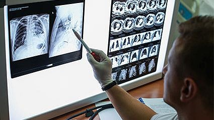 Experts Expand Criteria for Who Should Get Annual Lung Cancer Screening - Vimarsana News