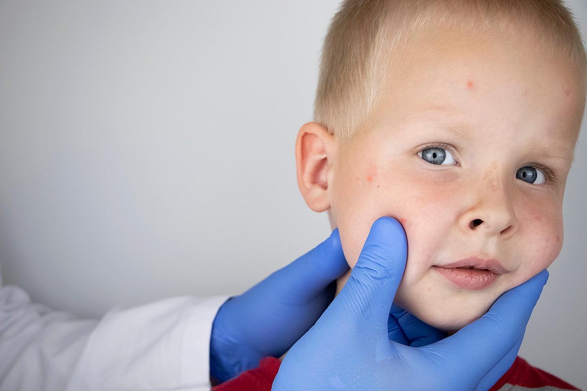 Measles Cases Surge Worldwide, Killing 136,000 Last Year - Vimarsana News