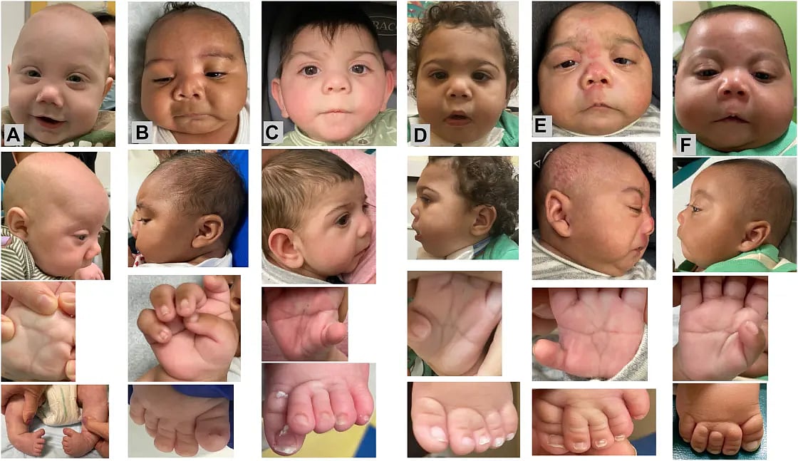 New Syndrome Linked to Fentanyl Found in Babies - Vimarsana News
