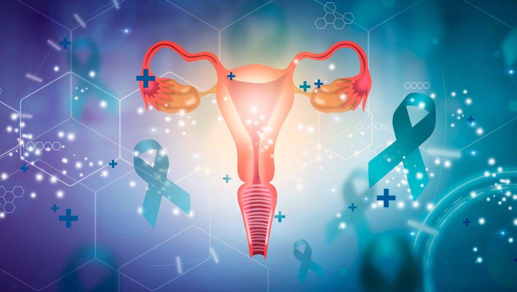 Endometriosis Linked to Four-fold Higher Odds for Ovarian Cancer
