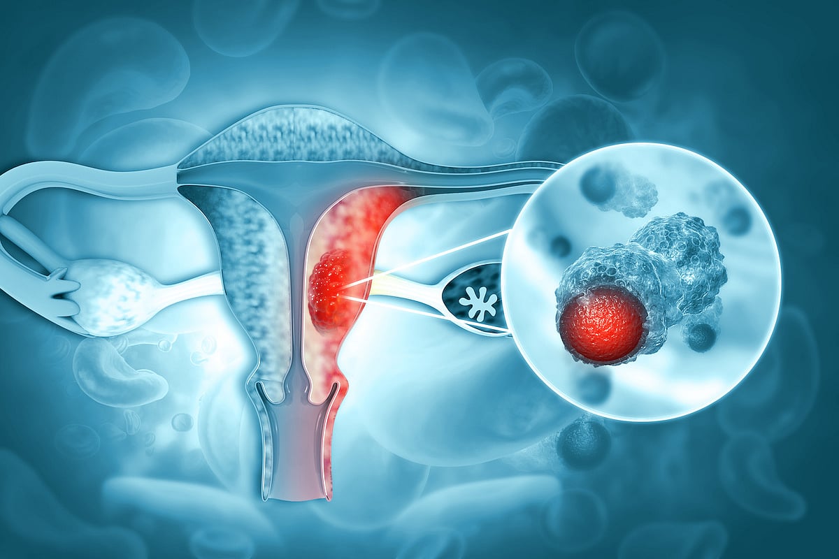 Many Women Don't Know This Warning Sign of Endometrial Cancer