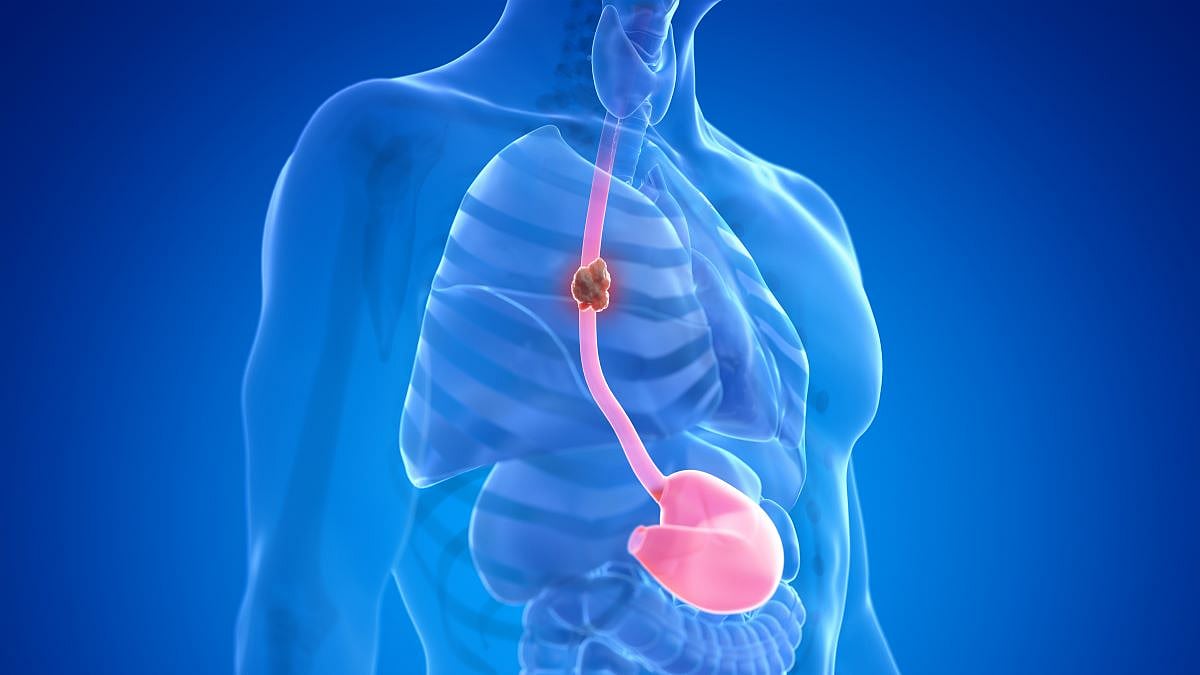 Esophageal Cancer: What It Is, Symptoms, and How It’s Treated