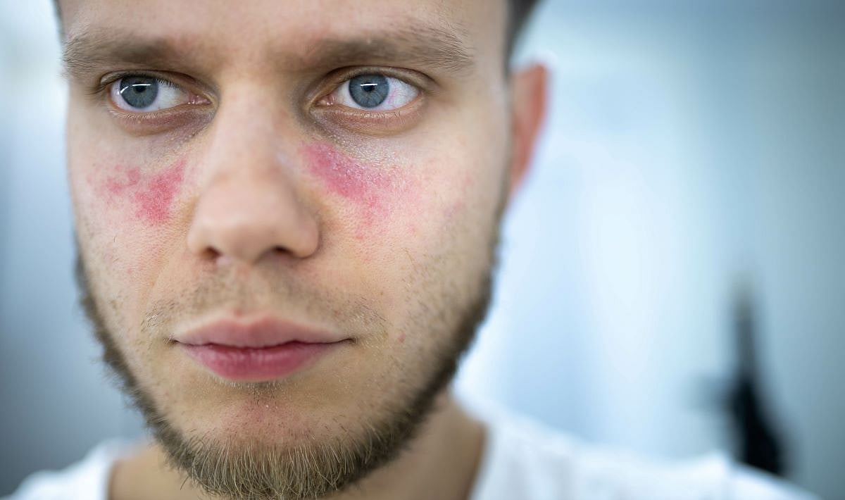 Drug Can Stave Off Organ Damage From Lupus