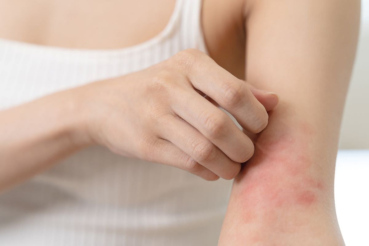 Obese Kids May Face Higher Odds for Eczema, Psoriasis
