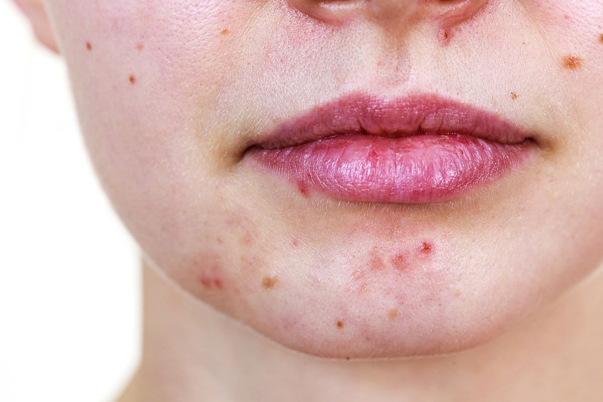 Common Acne Drug Might Become Carcinogenic at Room Temperature