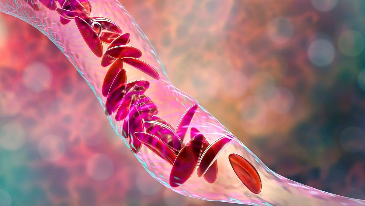 Common Sickle Cell Drug Won't Harm Female Fertility