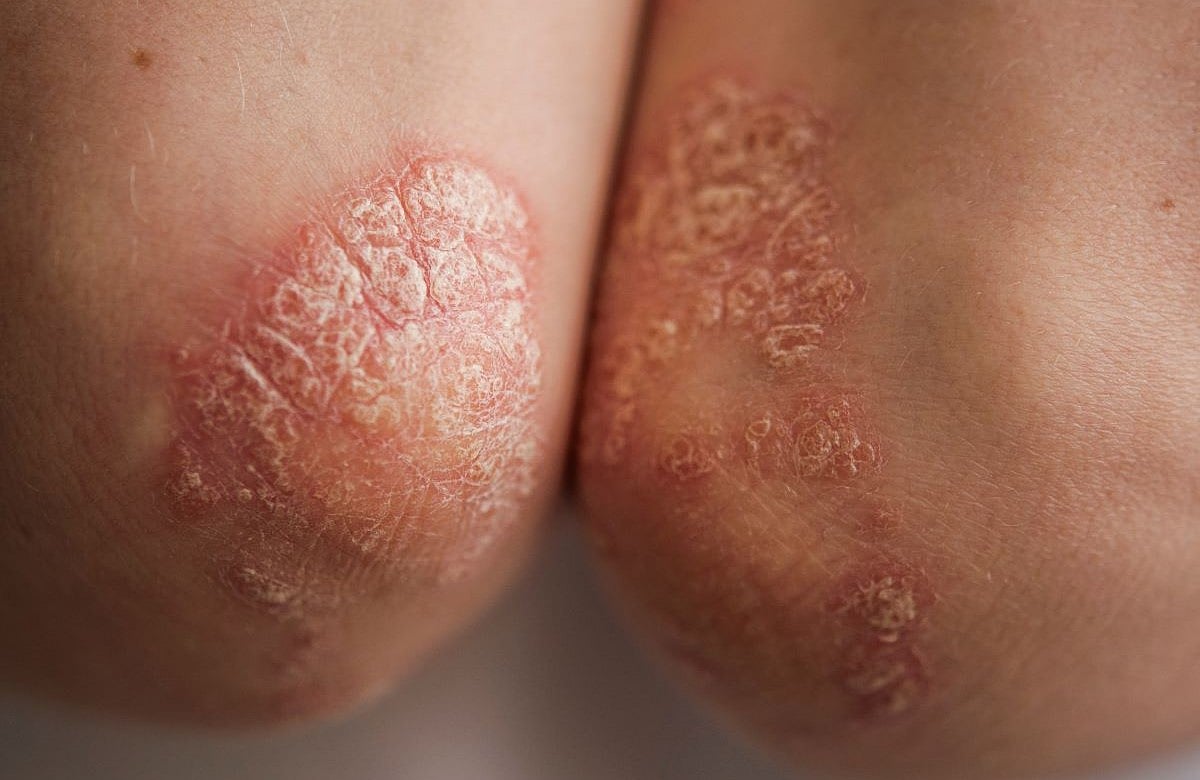 Belly Fat Linked To Psoriasis