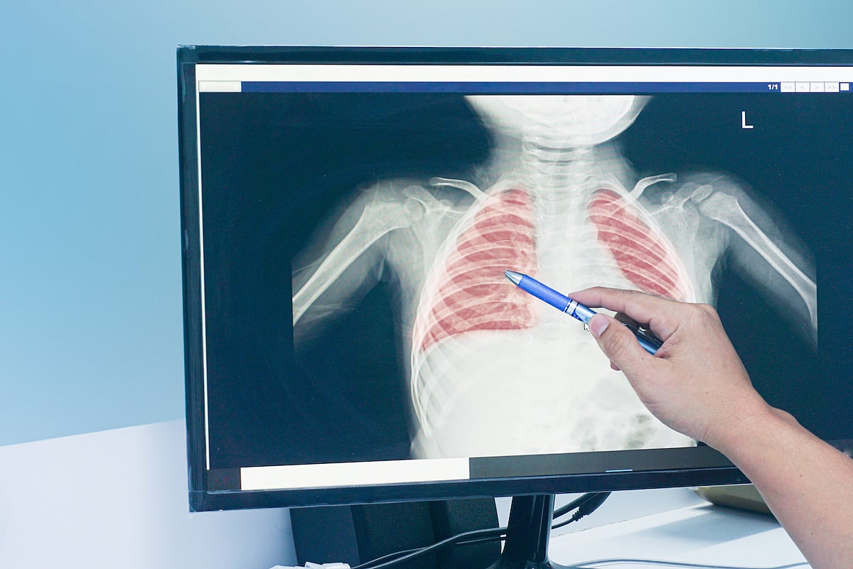 Some Cases of Recurrent Wheeze in Kids May Need New Treatment