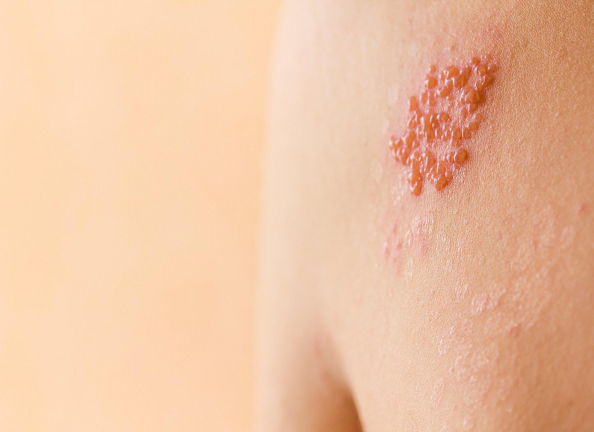 Bout of Shingles May Raise Odds for Cognitive Decline