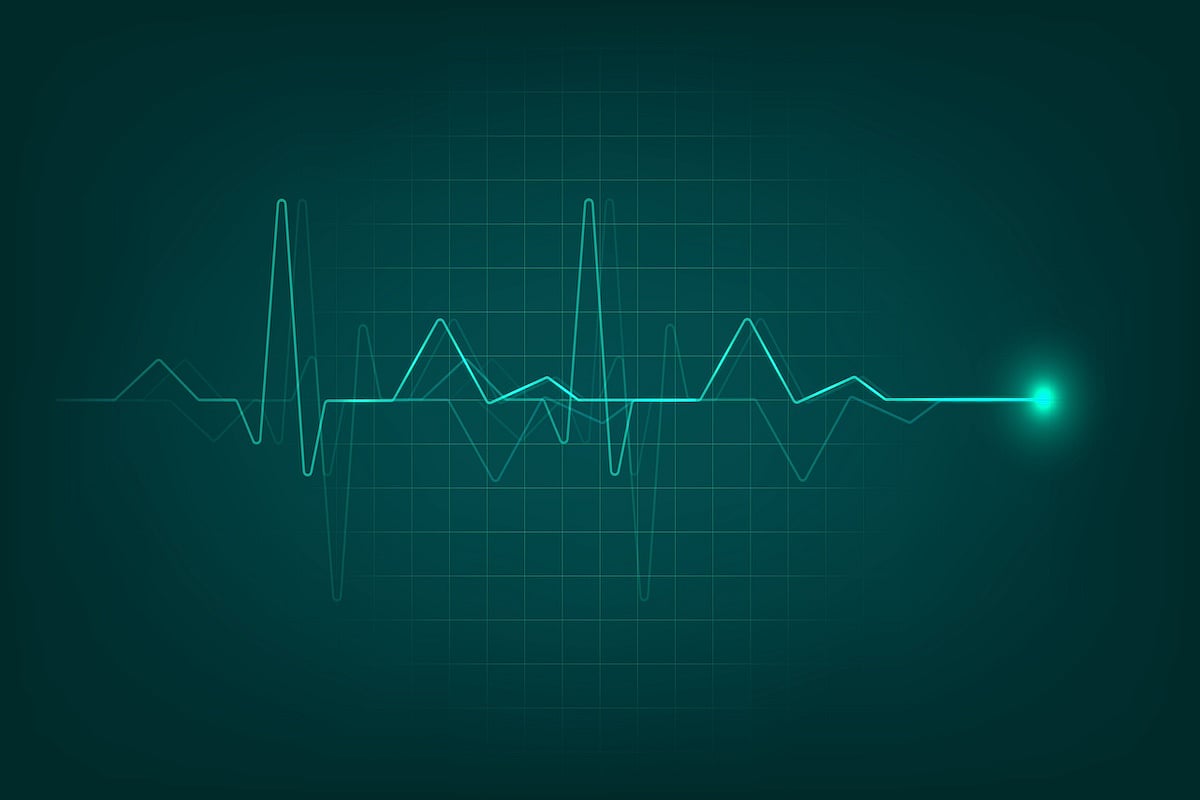 Ablation Best Treatment for Rapid Heartbeat in Heart Attack Survivors