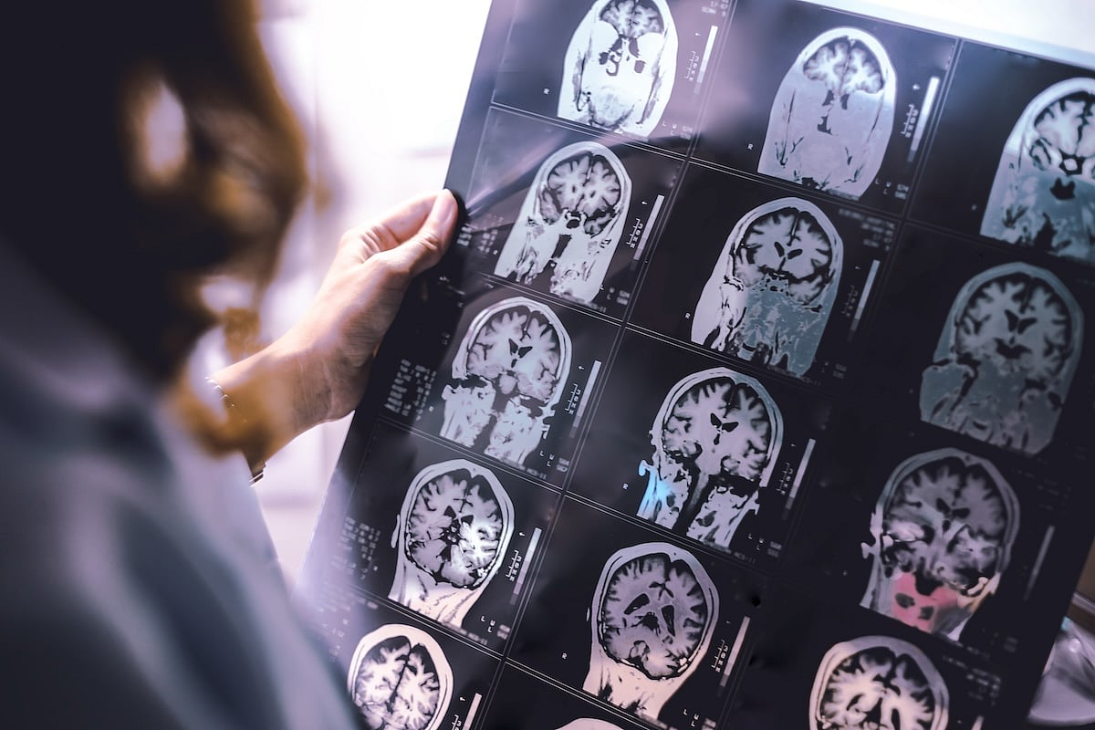 Could Having MS Help Shield Against Alzheimer's Disease?