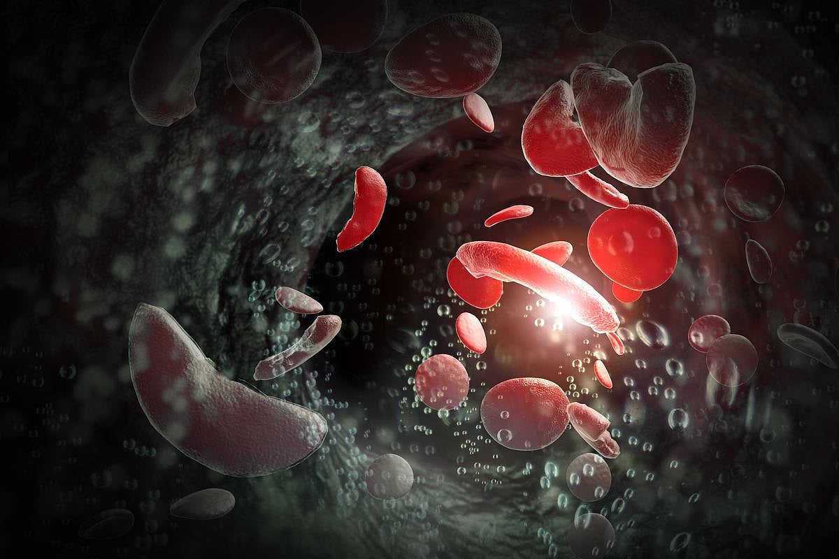 Stroke Rates Rising in Adults and Kids With Sickle Cell Disease