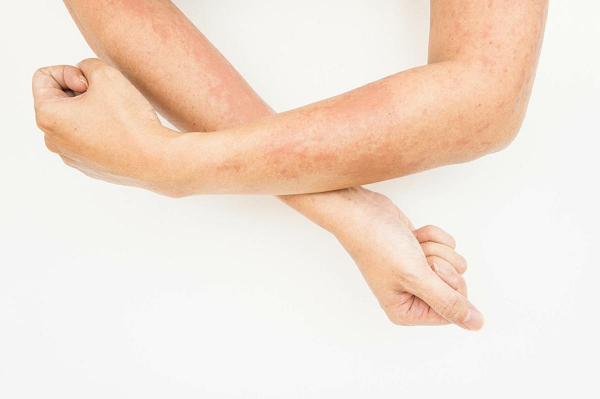 Breathing Dirty Air Might Raise Eczema Risks