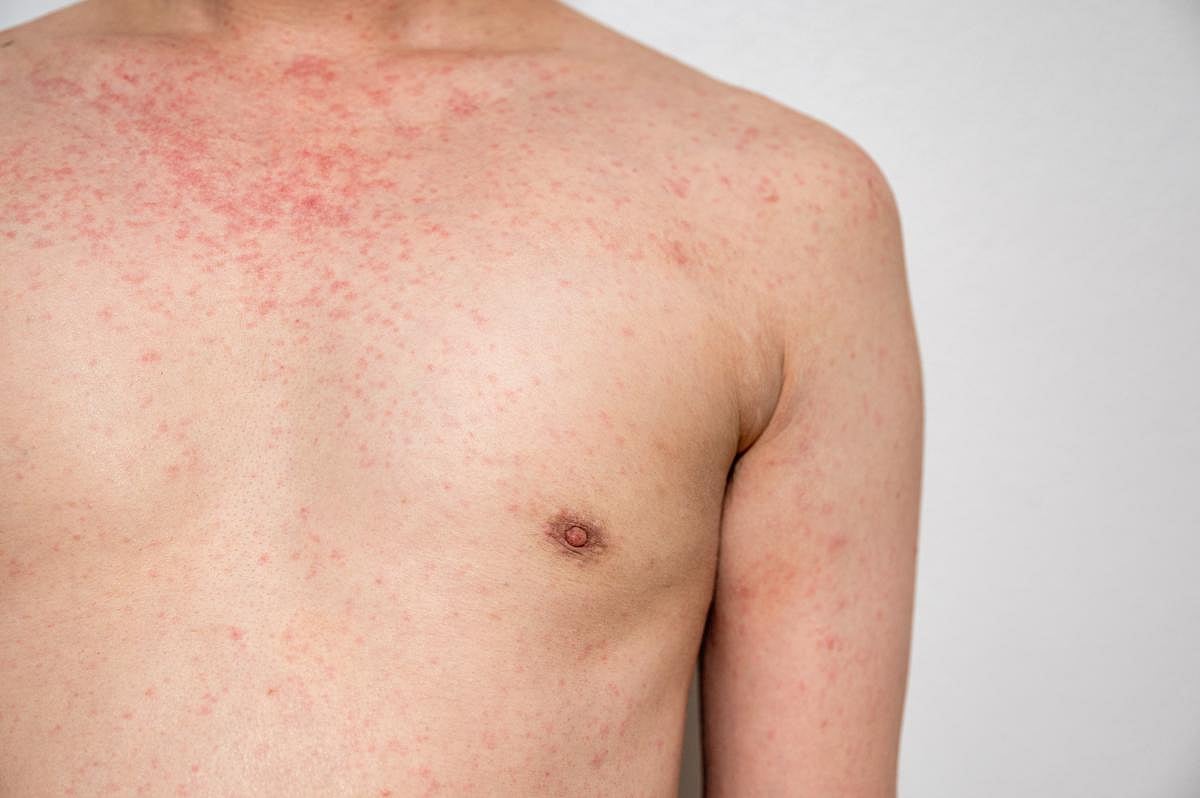 Measles Outbreak Leads to Dangerous Vitamin A Toxicity