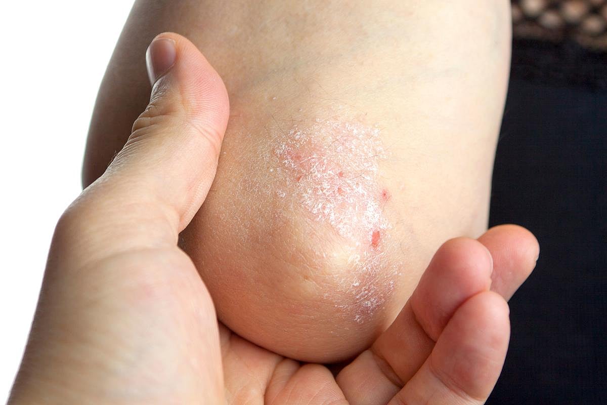 Psoriasis 101: Causes, Symptoms and Treatments, Explained
