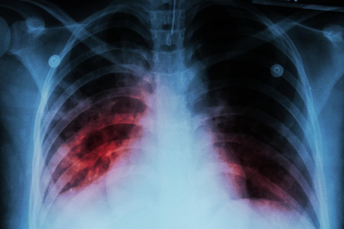 Once Again, Tuberculosis Becomes World's Top Infectious Disease Killer