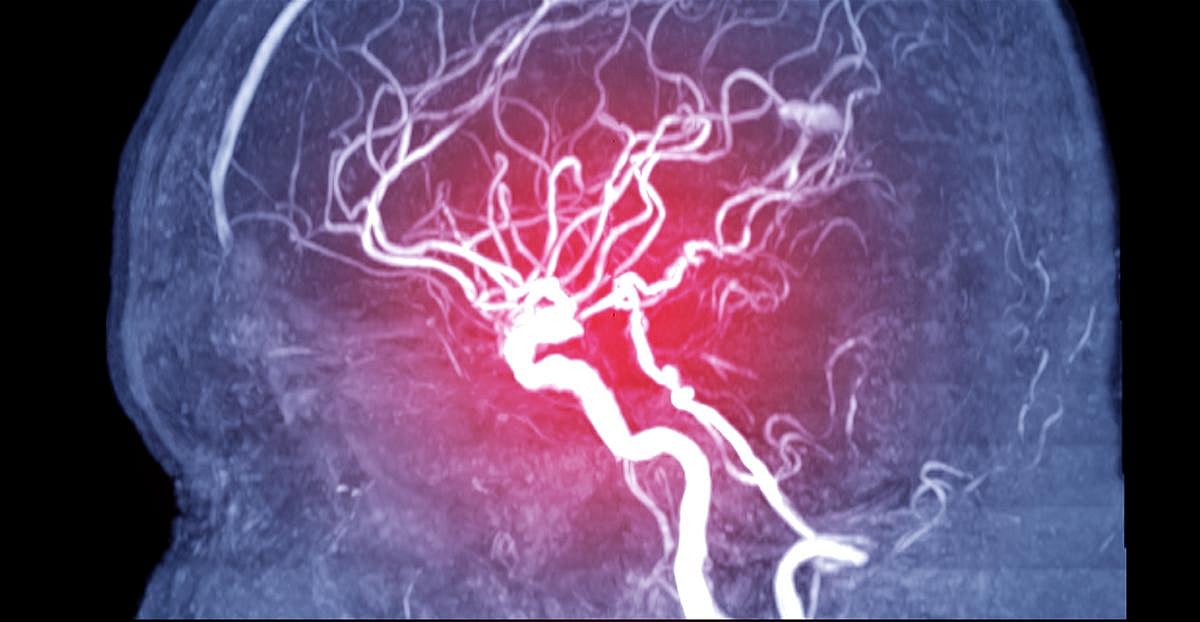 Brain Zap Treatment Could Get Arms, Hands Moving After Head Injury