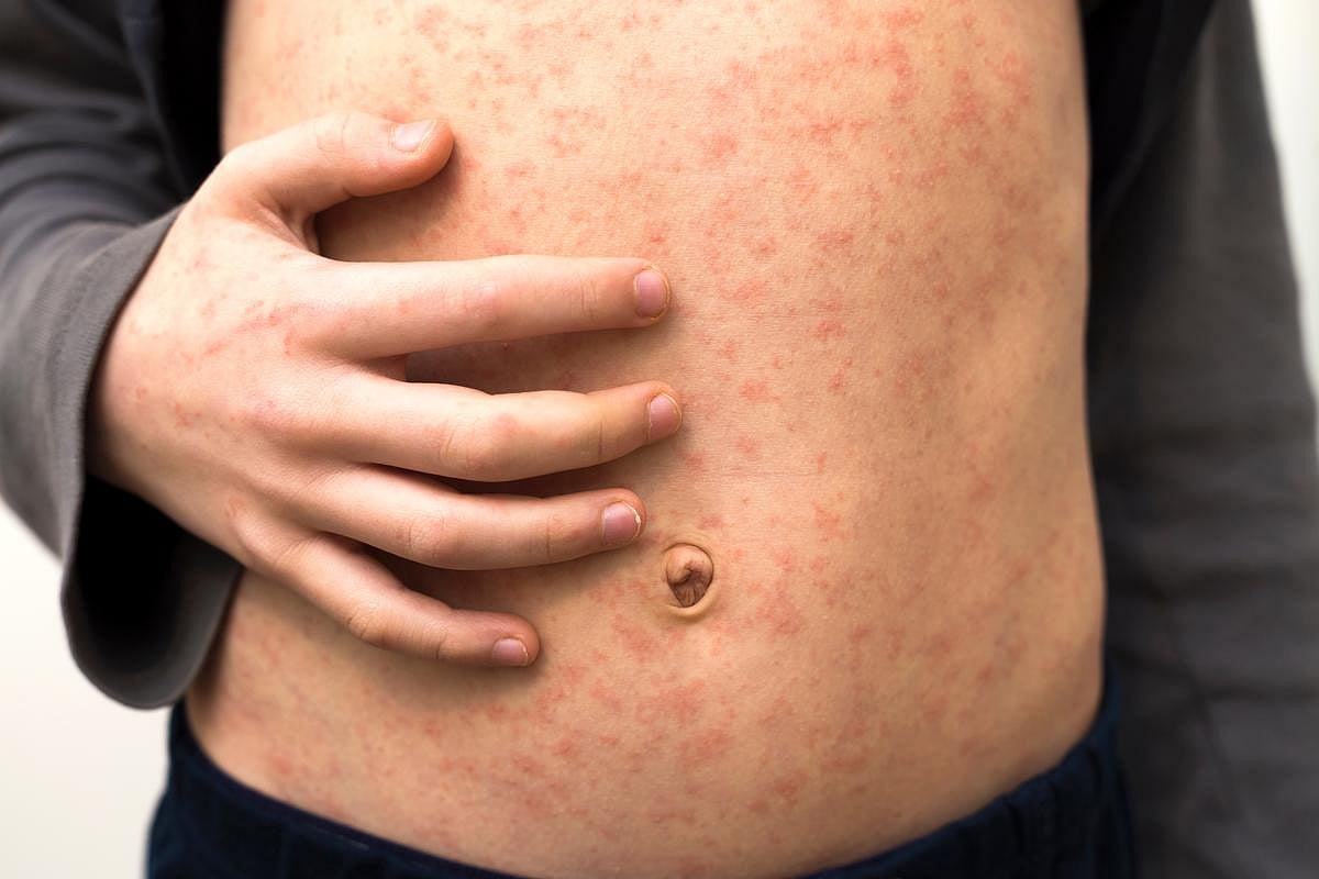 Falling Vaccination Rates Brings Spikes in Measles Worldwide