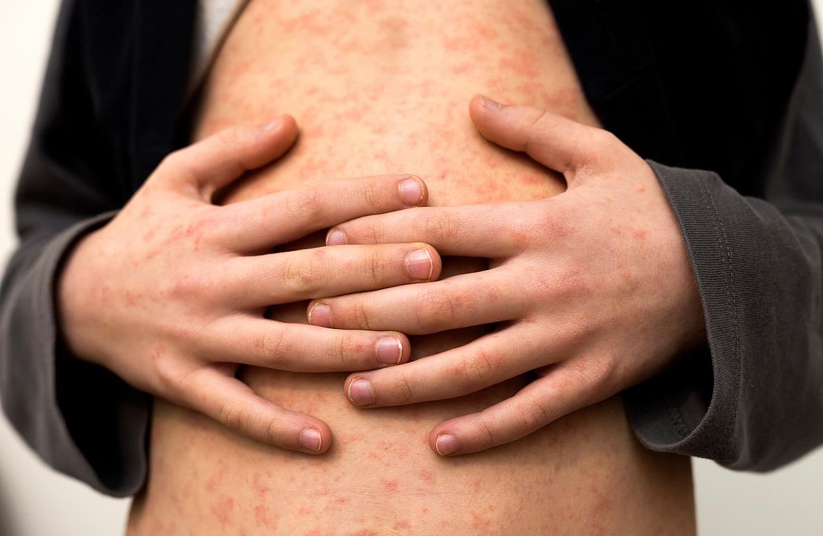 U.S. Faces Largest Measles Outbreak Since 2000
