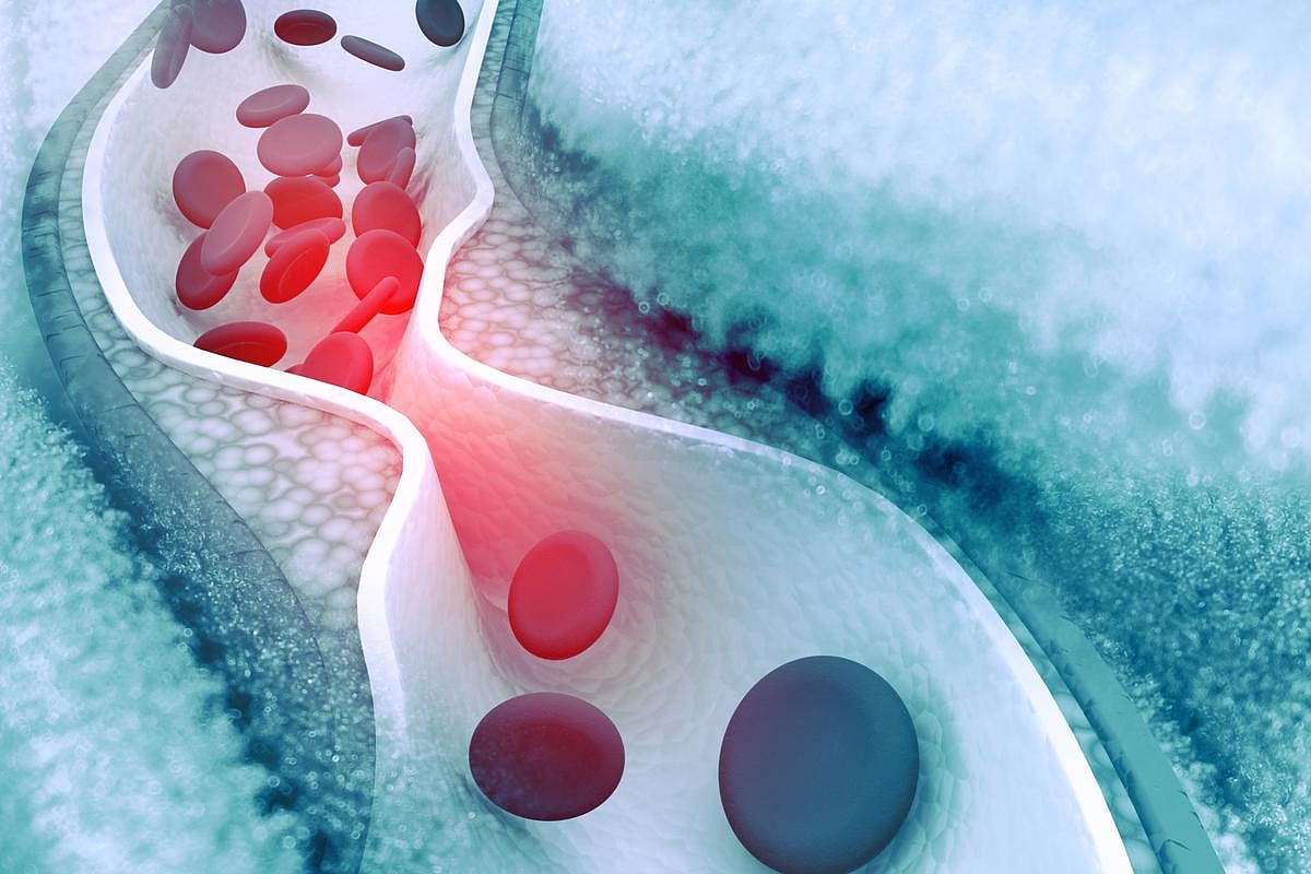 Buildup of Metals in Body Can Worsen Heart Disease