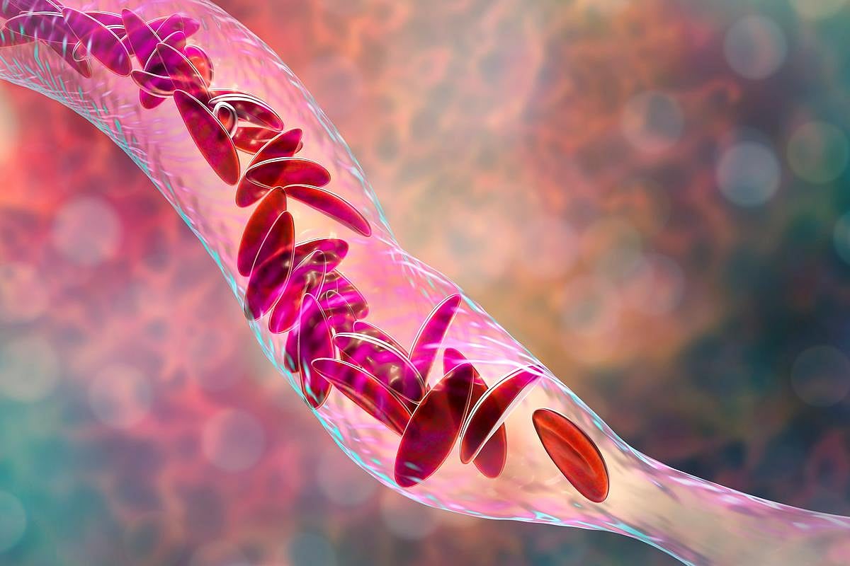 First Patient Cured of Sickle Cell Anemia