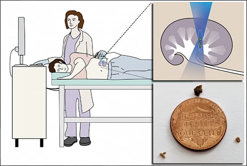 Sometimes Kidney Stones Need a Little Nudge, Study Finds