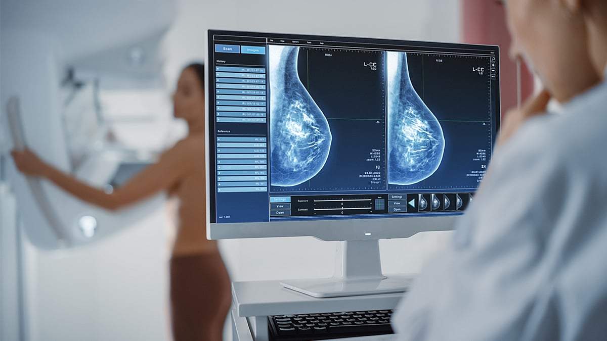 AI Reads Multiple Mammograms to Help Predict Breast Cancer Risk