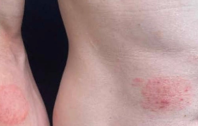 Doctors Report First U.S. Cases of Sexually Transmitted Ringworm Rash