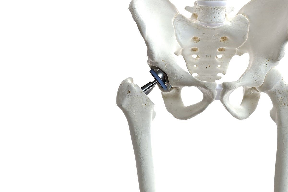 Muscle Quality Could Be Key To Successful Hip Replacement