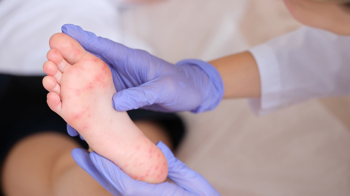 CDC Sends Experts to Texas as Measles Outbreak Grows