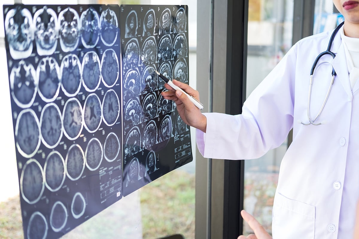 New Clot-Busting Drug Quicker And As Effective In Treating Stroke