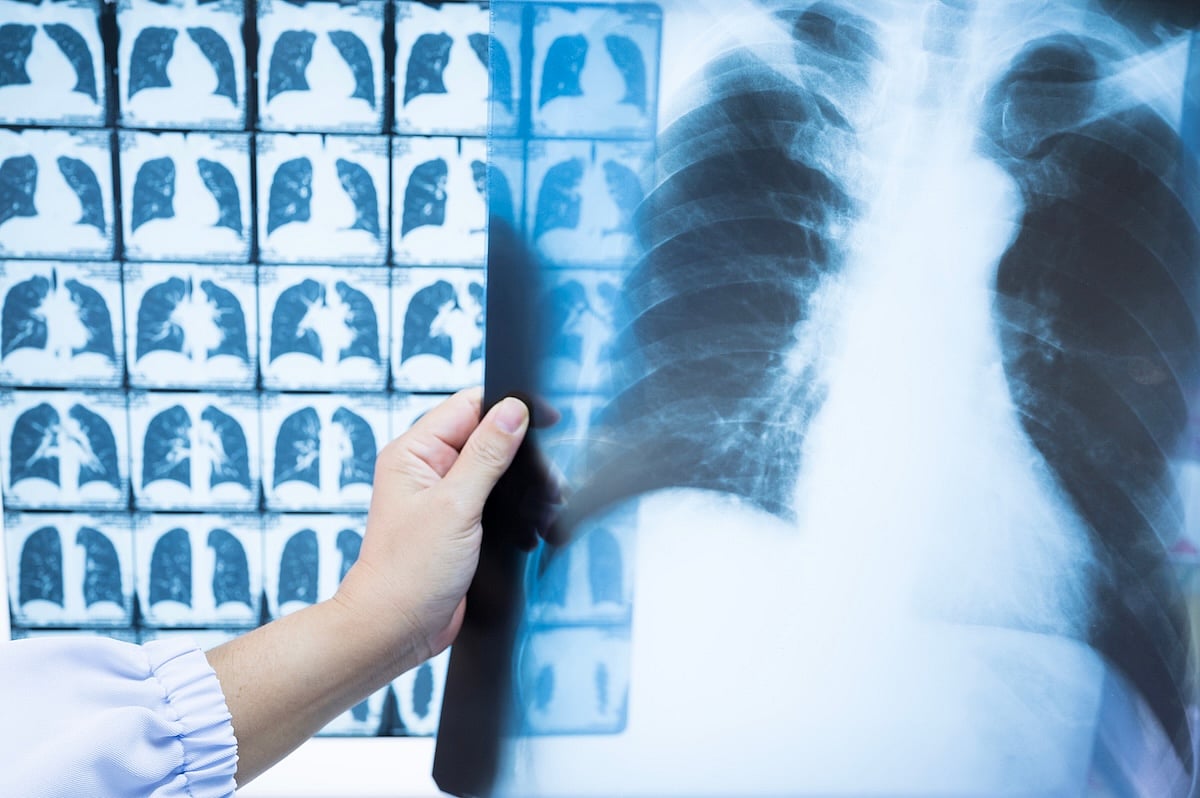 New Guidelines Upped Lung Cancer Screenings, But Gaps Remain