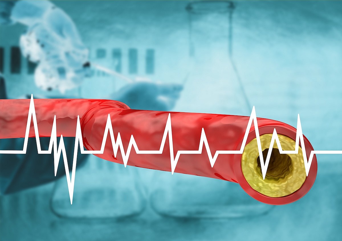 Scoring System Can Avoid Unnecessary Surgery For Clogged Arteries