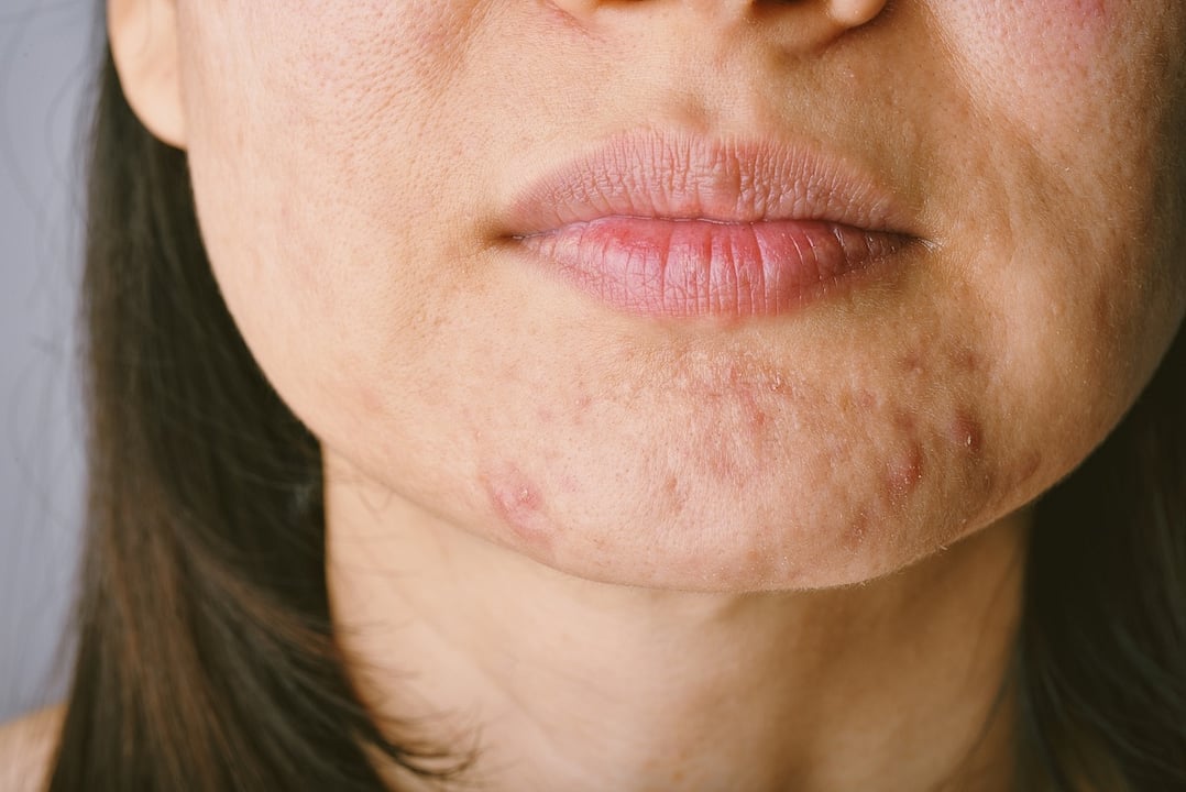 Adult Acne Increases Risk Of Eating Disorders