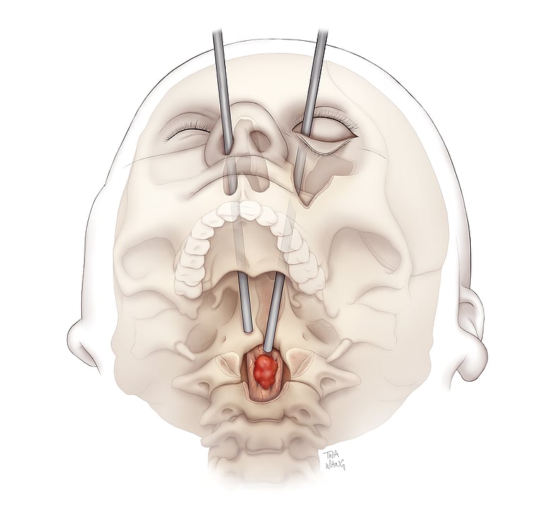 First-Of-Its-Kind Surgery Uses Eye Socket To Remove Spinal Cancer