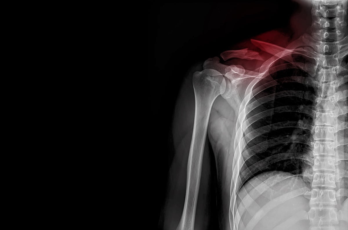 Broken Collarbone Hospitalizations Increase Among Children