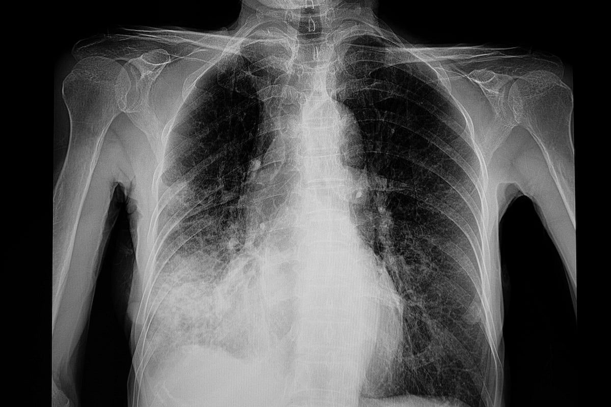 Arizona Resident Dies From Pneumonic Plague