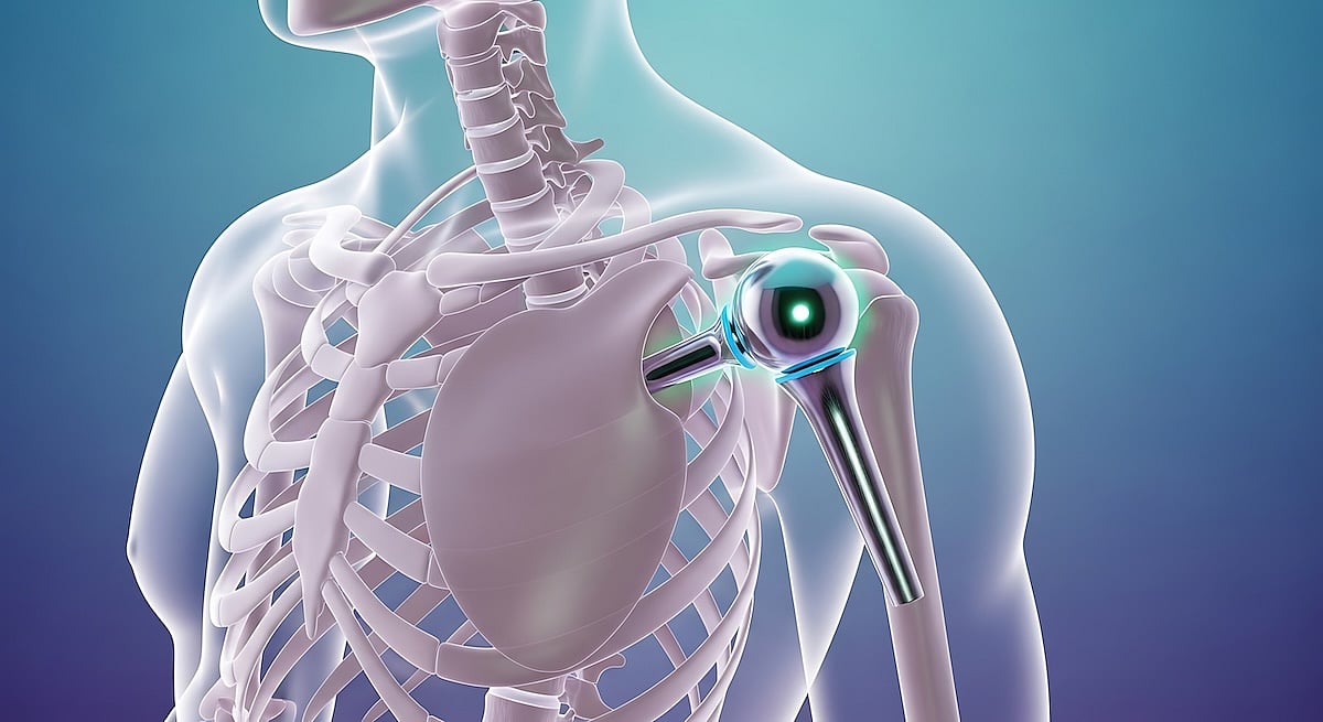 Obesity No Barrier For Shoulder Replacement Surgery, Study Finds