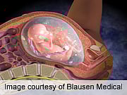 Neonatal Vitamin K Refusal Tied to Nonimmunization